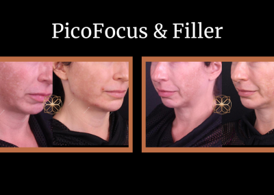 Picofocus and filler before and after