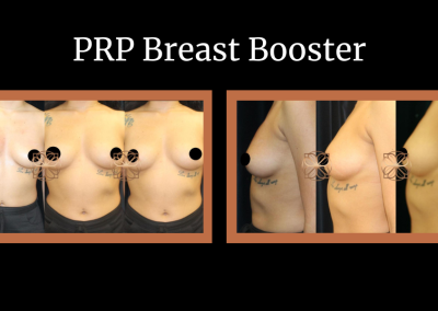PRP Breast Booster before and after