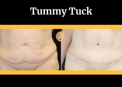 Tummy tuck