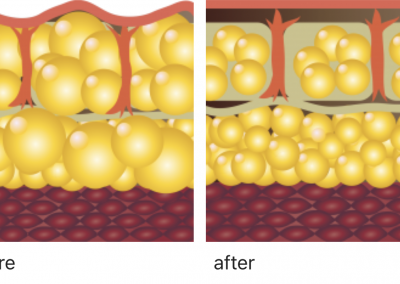 Zimmer Z Wave before and after 2