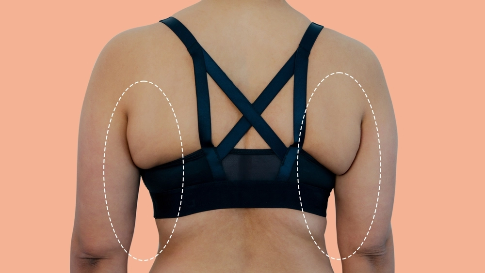 AccuTite treatment benefits for reducing bra fat and achieving body contouring results.