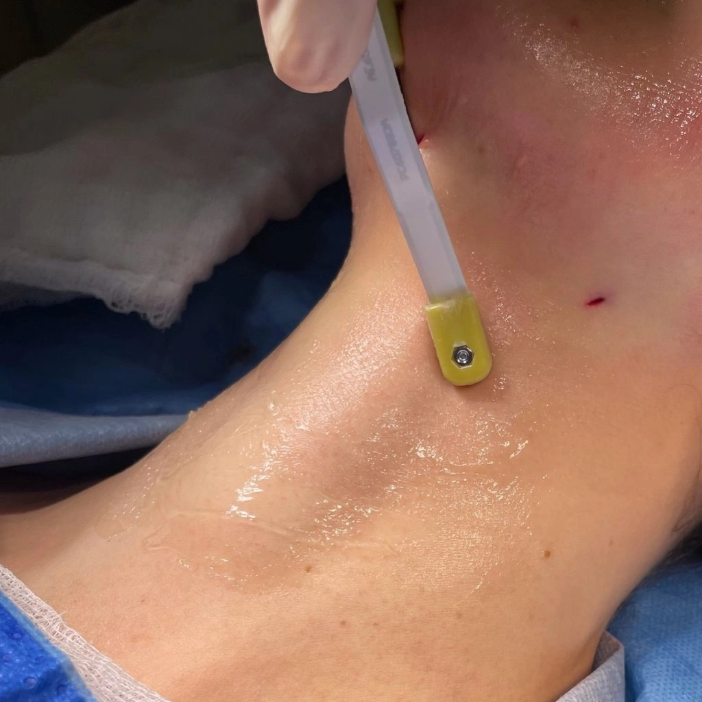 AccuTite procedure on the neck area showing precise treatment with specialized device.