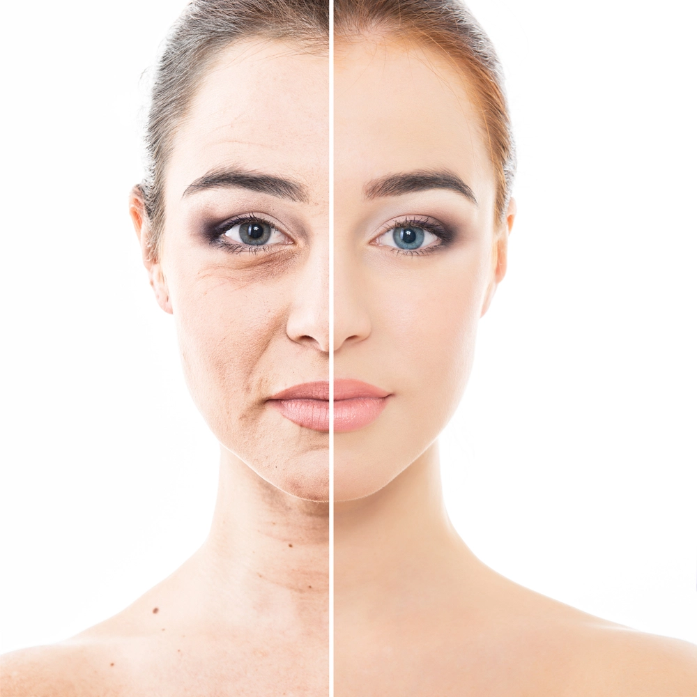 Before and after results of AccuTite procedure showcasing facial rejuvenation and skin tightening.