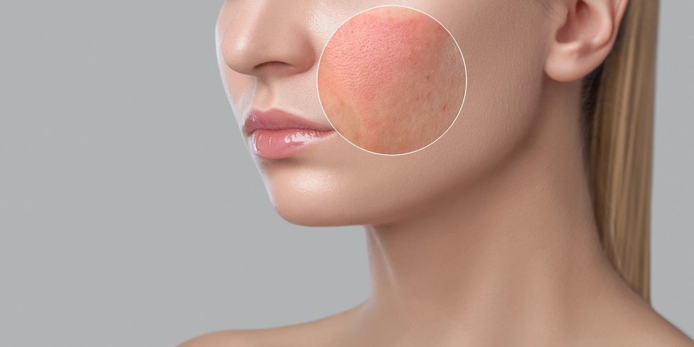 am-i-candidate-for-accutite-procedure-consultation-new