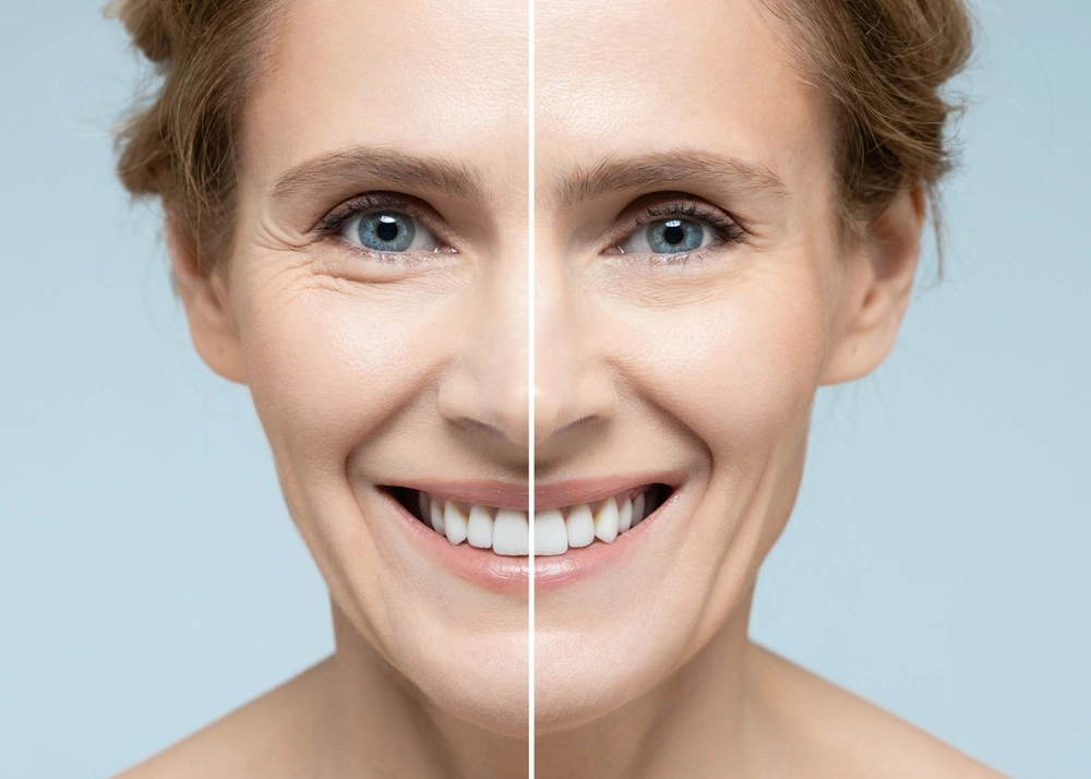 Patient showing radiant skin post Quantum RF InMode treatment with visible recovery benefits.