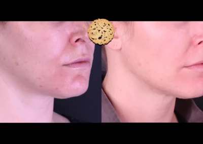 Angled view of jawline before and after Restylane Lyft procedure