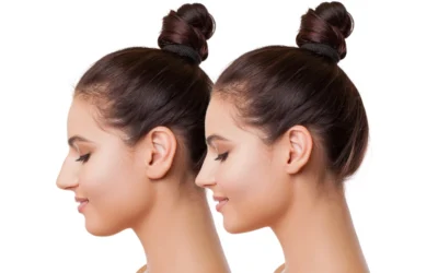 AccuTite vs. Traditional Liposuction: Which is Better for You?
