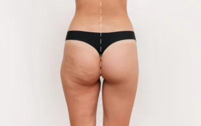 Cellfina vs Other Cellulite Treatments: A Comparative Analysis