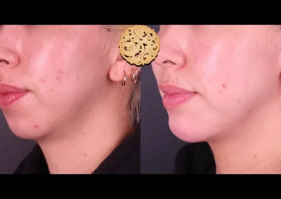Side comparison of chin contouring with Restylane Lyft