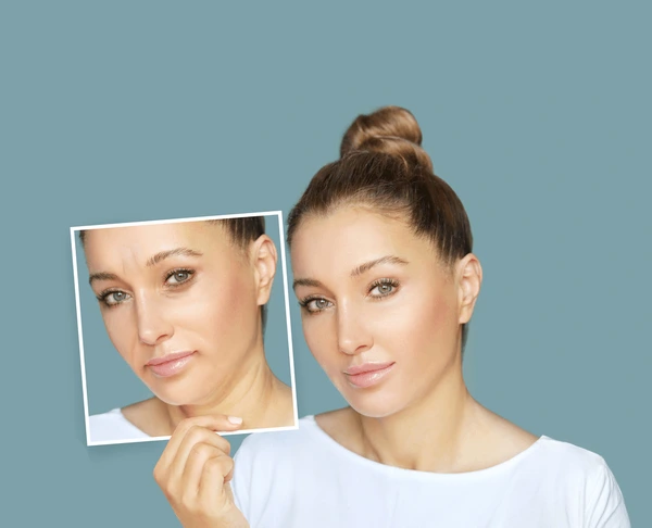 Woman presenting before and after images of Dysport treatment results