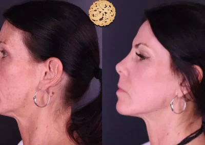 Erbium laser- left profile