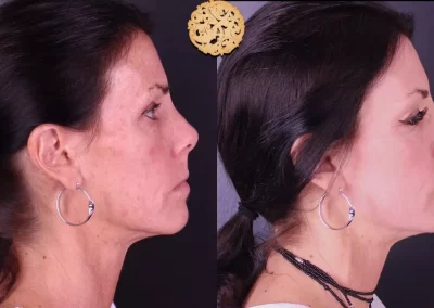 Erbium Laser Right profile of client