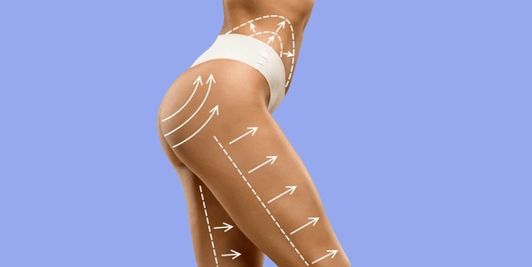 Illustration of targeted treatment areas for Evolve fat reduction procedure, focusing on body contouring and fat reduction