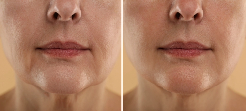 Before and after Facetite treatment results with reduced sagging and improved contour.
