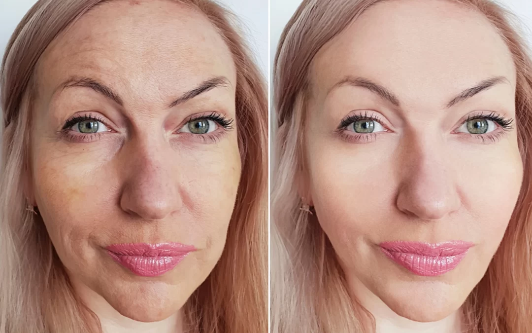 Halo Fractionated Resurfacing Beverly Hills