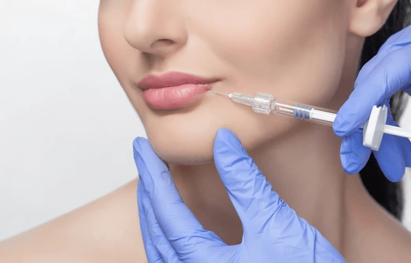 Juvederm Ultra XC lip filler injection enhancing lip volume, shape, and smoothness for natural-looking lip augmentation results