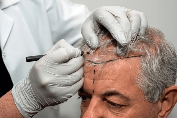 Marking the hairline during preparation for NeoGraft hair transplant treatment to ensure precision
