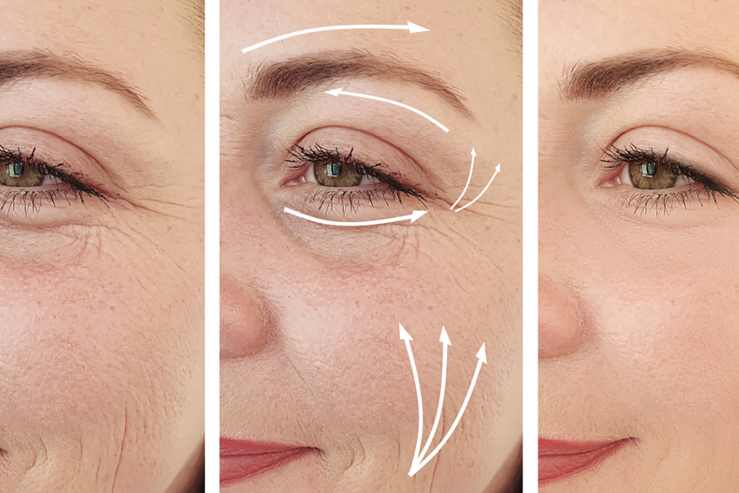 Pelleve Skin Tightening Spa26 Beverly Hills Pelleve Skin Tightening Spa26 Beverly Hills
