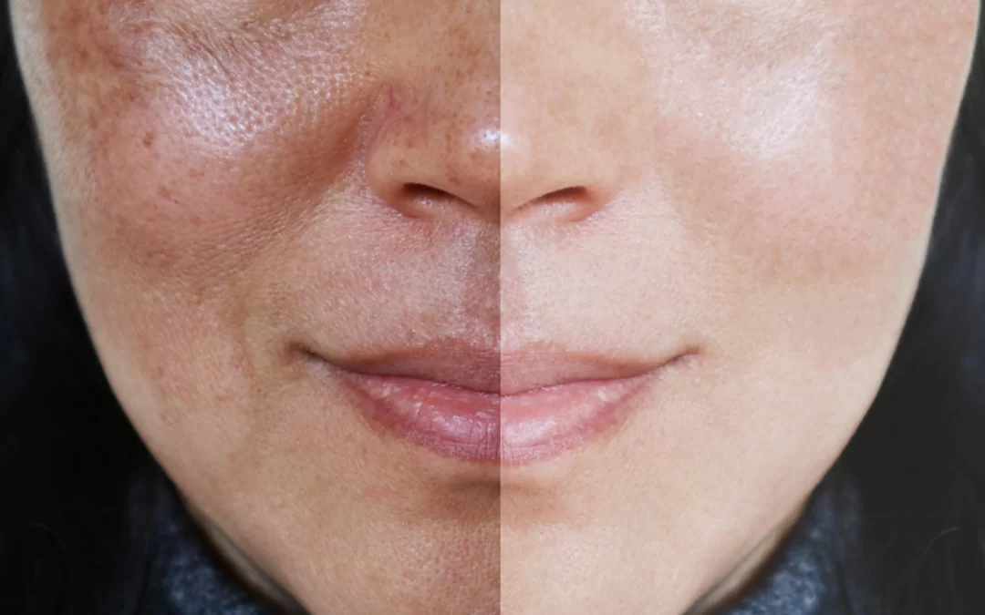 Power Peel for Melasma Beverly Hills