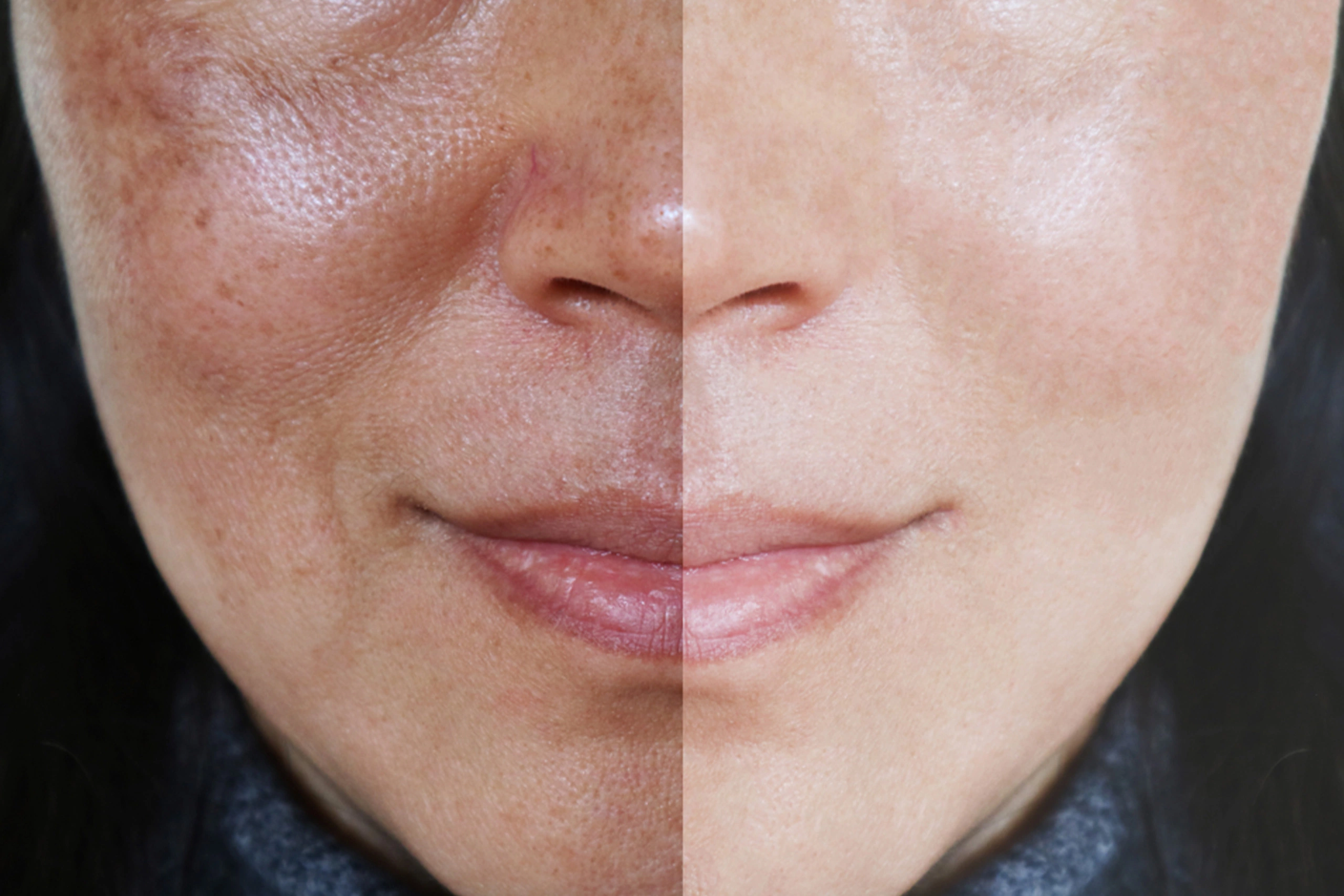 Power Peel For Melasma Spa26 Beverly Hills Power Peel For Melasma Spa26 Beverly Hills