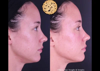 Profile view before and after Restylane Lyft enhancements on female cheeks.