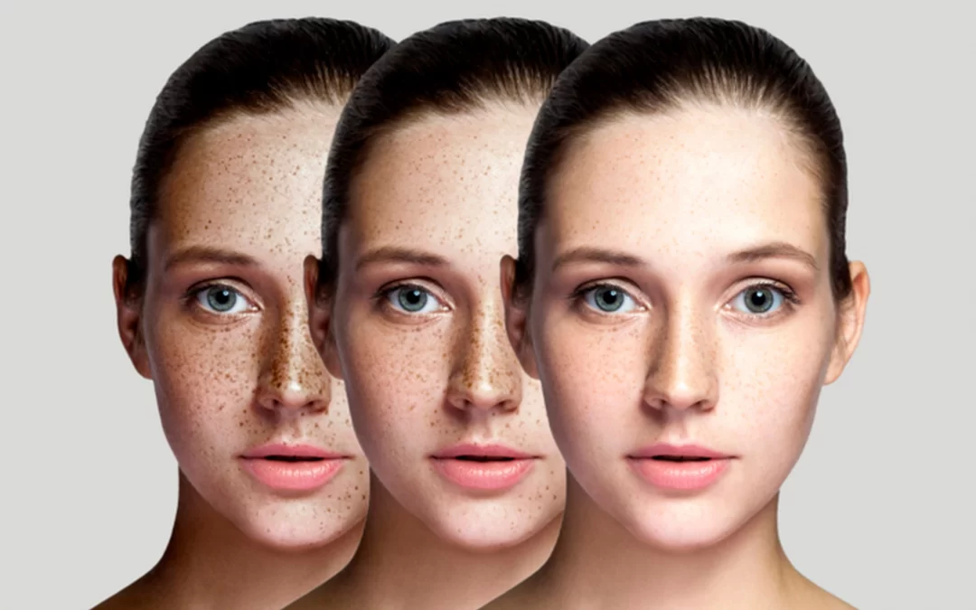 ProFractional Laser Treatment Cost in Beverly Hills