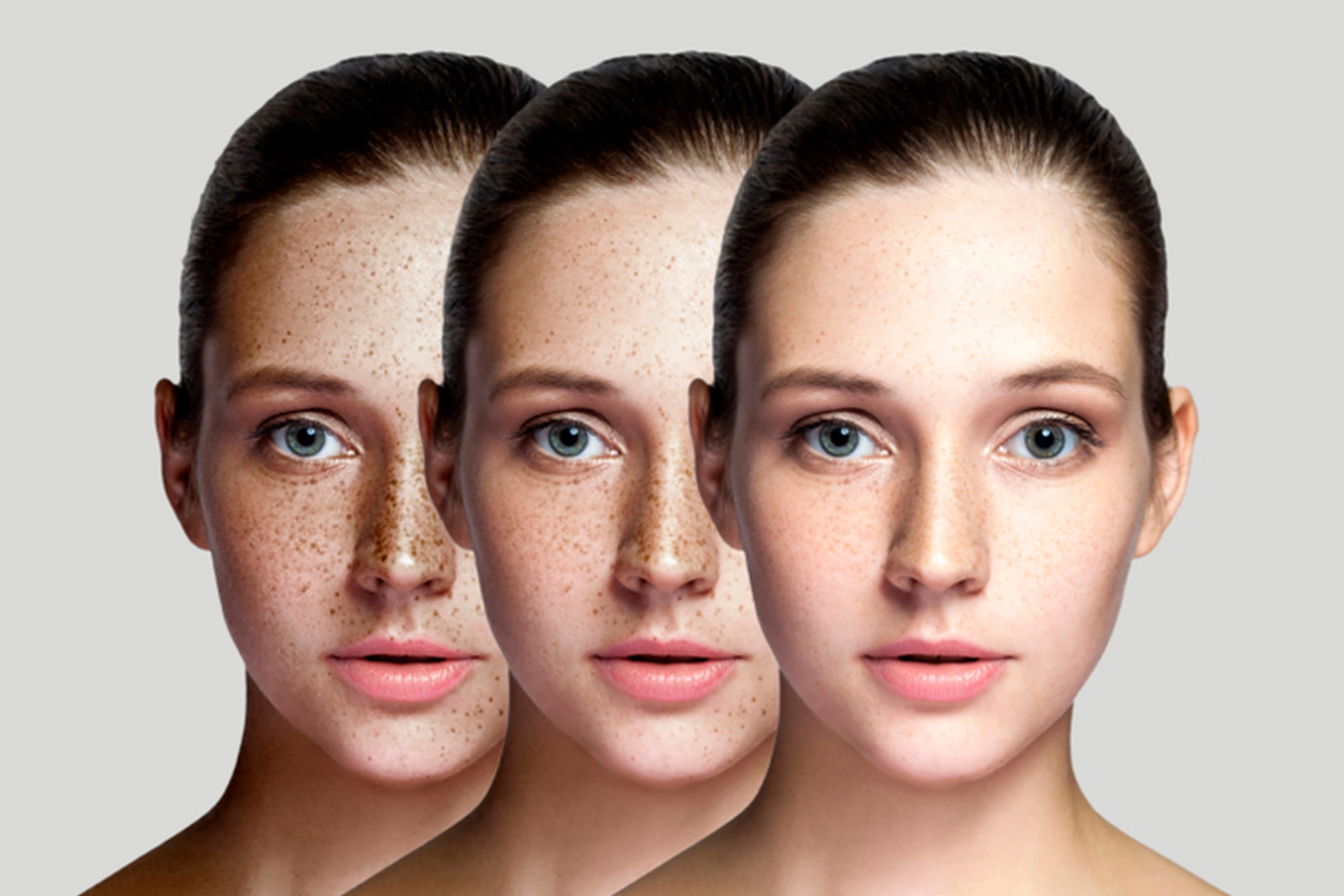 ProFractional Laser Treatment Spa26 Beverly Hills ProFractional Laser Treatment Spa26 Beverly Hills