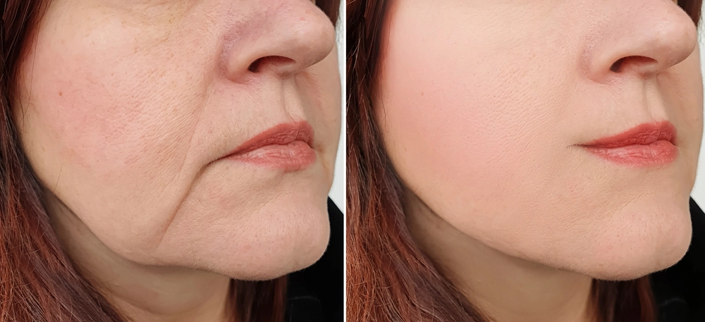 Before and after results of Quantum RF InMode treatment for skin rejuvenation.