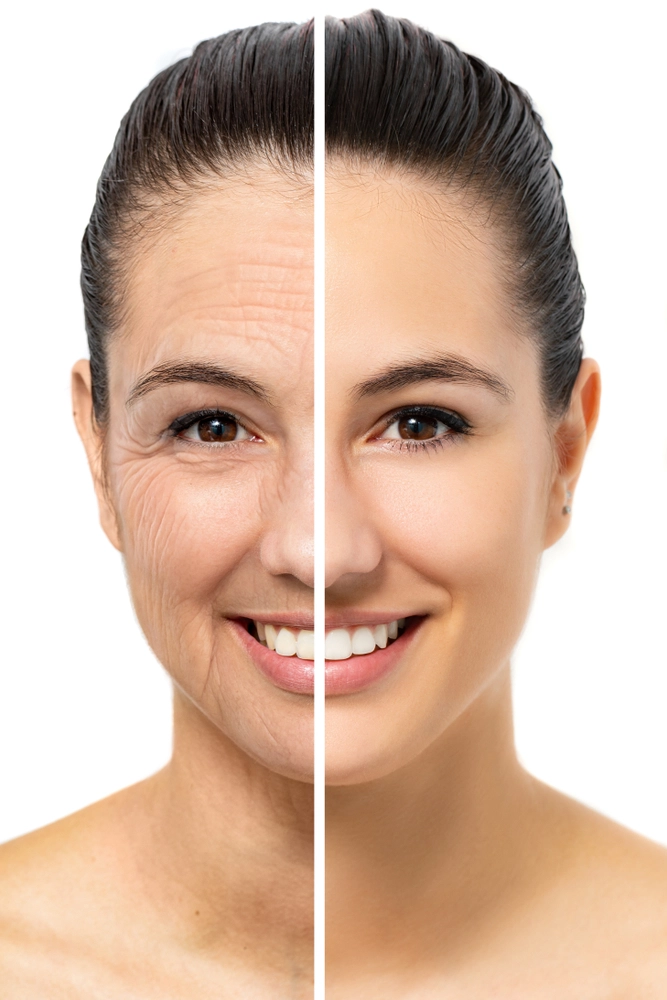 Before and after results showcasing the skin rejuvenation benefits of Quantum RF InMode treatment.