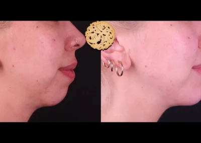 Angled view before and after chin enhancement with Restylane Lyft.