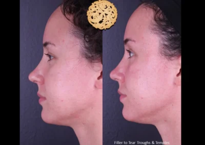 Before and after Restylane Lyft treatment on woman's tear troughs and temples.