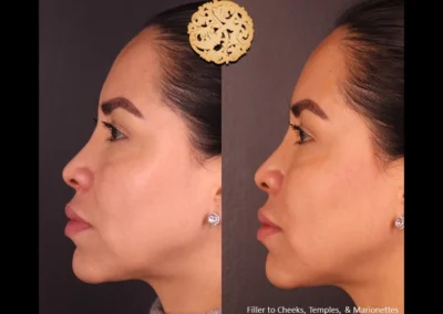 Restylane Lyft cheek and temple enhancement side profile before and after.