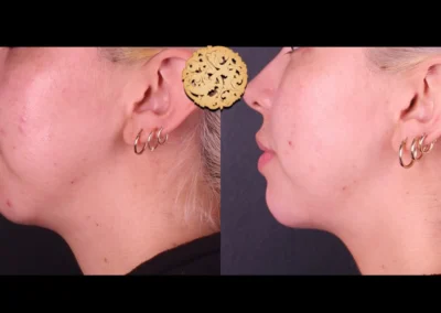 Side profile before and after Restylane Lyft chin augmentation.