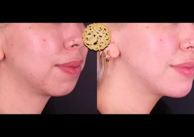 Frontal view Restylane Lyft enhanced chin and jawline results