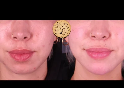 Frontal comparison of Restylane Lyft treatment on chin