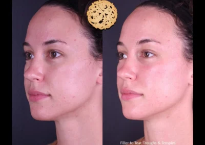 Before-and-after side profile of Restylane Lyft facial filler treatment