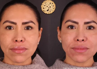 Front view of Restylane Lyft facial filler results on cheeks and marionettes.