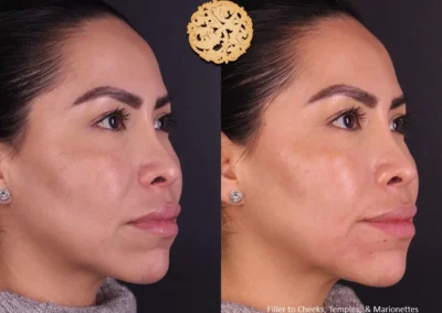 Full face comparison before and after Restylane Lyft for facial volume.