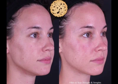 Restylane Lyft filler before-and-after results on woman's tear troughs and temples.