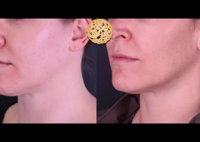Restylane Lyft jaw enhancement before and after side profile.