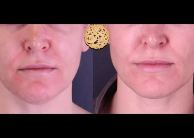 Frontal comparison before and after Restylane Lyft jaw treatment.