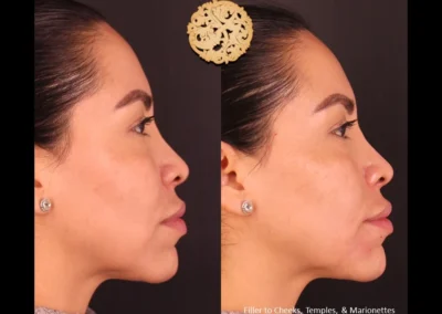 Comparison side profile of Restylane Lyft treatment on facial contours.