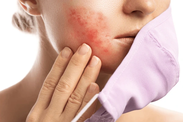 Close-up of a woman's cheek showing redness and irritation, illustrating possible side effects of GenesisV Laser Treatment