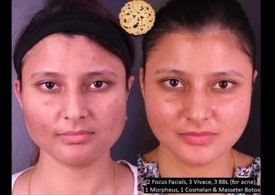 Female before and after Vivace microneedling with additional facial treatments for clear skin.