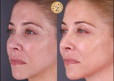 Before and after Vivace microneedling treatment results.
