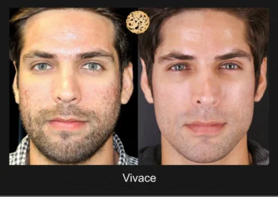 Male before and after results of Vivace microneedling treatment.