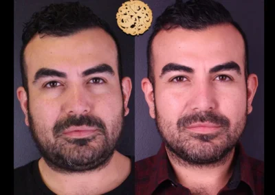 Male before and after Vivace RF microneedling for improved skin texture.