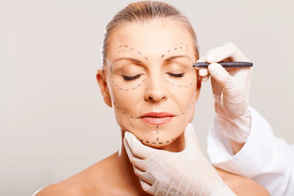 Marking treatment areas on the face before Vivace RF microneedling for precise skin tightening and rejuvenation