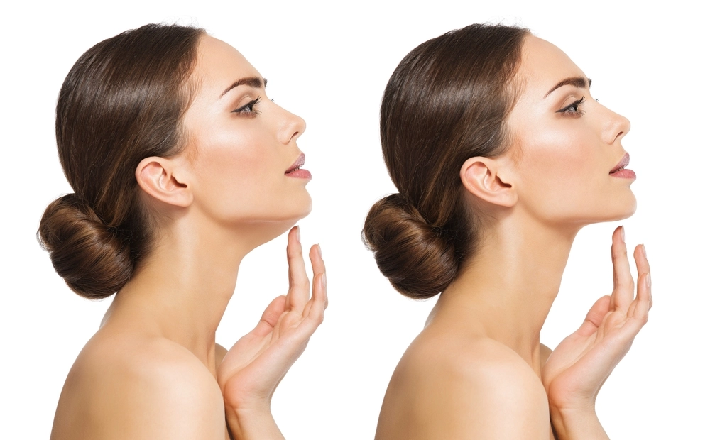 before and after comparison of Facetite treatment results for improved jawline contouring.