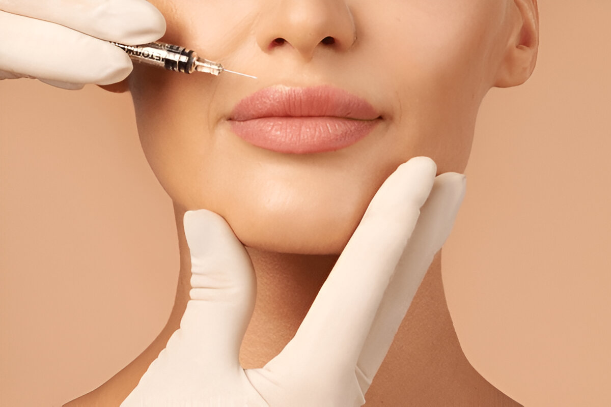 what-is-juvederm-ultra-plus-xc-injection Close-up of Juvederm Ultra Plus XC injection for plumping lips and reducing wrinkles to enhance natural facial contours
